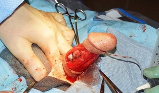 pénisznagyobbító műtét